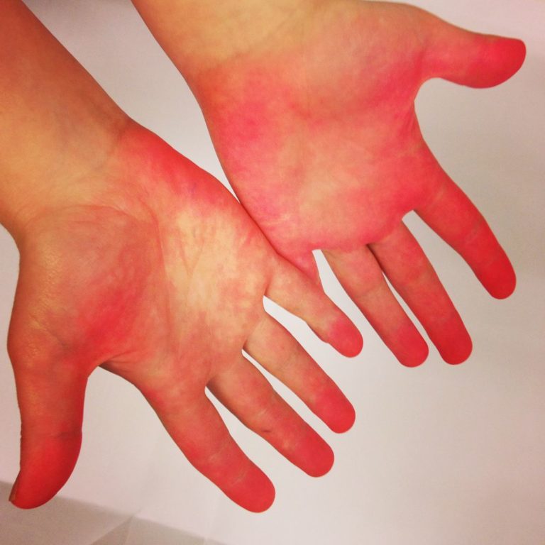 A white person's hands, with pink ink along the palms and fingers